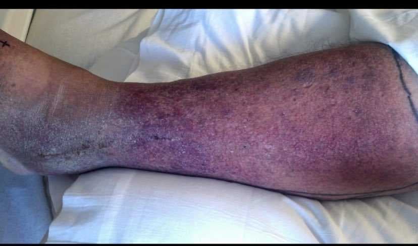 Flesh-eating bacteria cases in Florida double after Milton and Helene; health department says