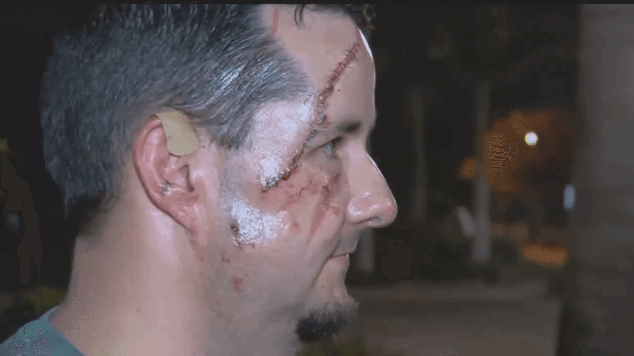 Previous Southwest Florida bear attack left man with 41 stitches in 2018